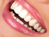 ציפוי שיניים מחרסינה להלבנת שיניים