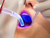 טיפול שיניים בלייזר - יתרונות
